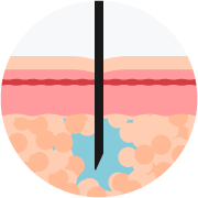 Inyección tradicional